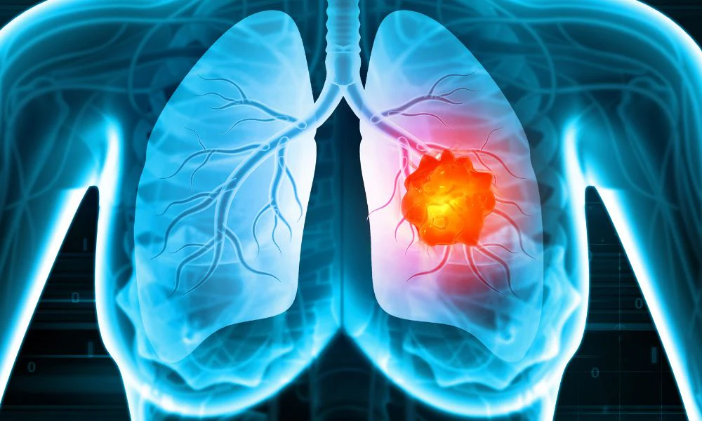 Asbestos exposure and its link to lung cancer over time